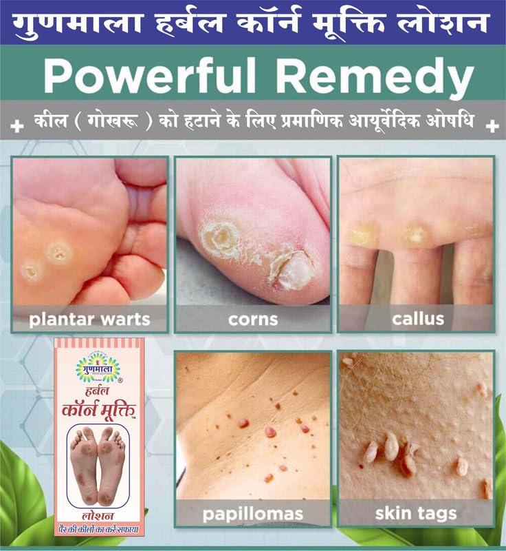 Gunmala Herbals Corn Mukti (Kill) Lotion | Kaal Aani Cream Foot Remover Callus & Kapasi Removal Paste For Removes Corns Relives From Pain Pinch In Walking - 30 ml.