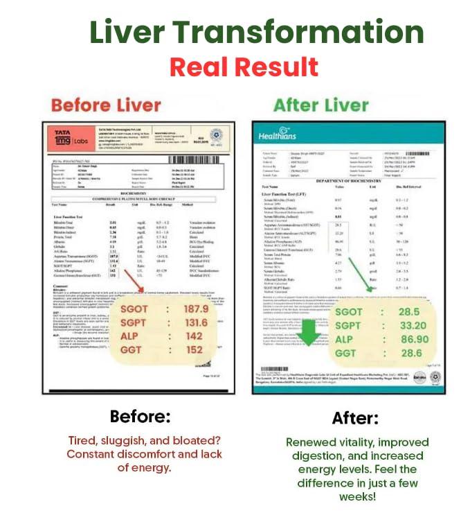Divya Shree Divya Shree Liver Detox Capsule Helps In Fatty Liver | Helps in Better Liver Health | Promote Natural Liver Detoxification (60 Capsule)