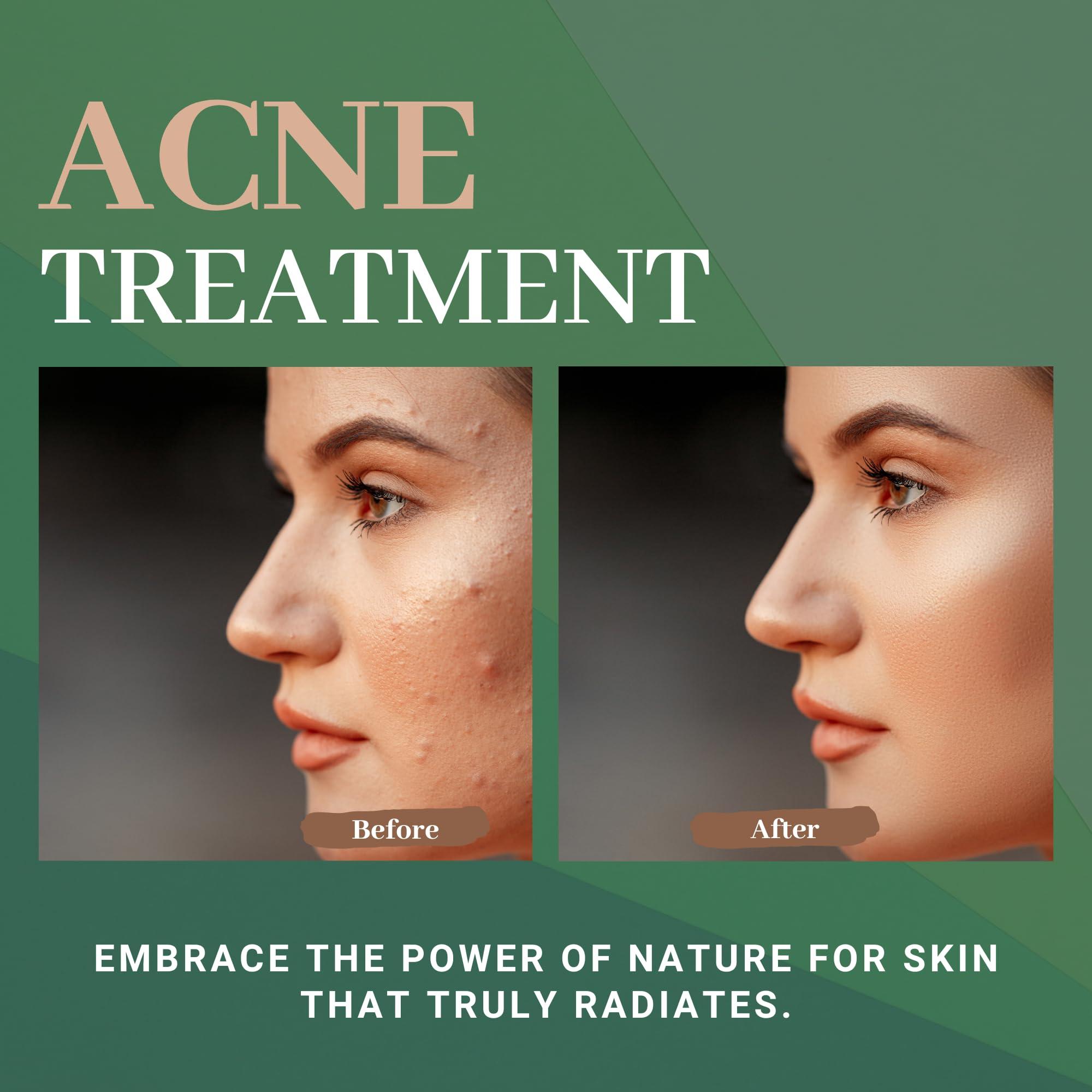 Healthy Nutrition - Just for the Health of it Healthy Nutrition - Just for the Health of it Neem For Acne Free Skin, Blood Purifier To Reduce Pimples On Face (60 Tablets)