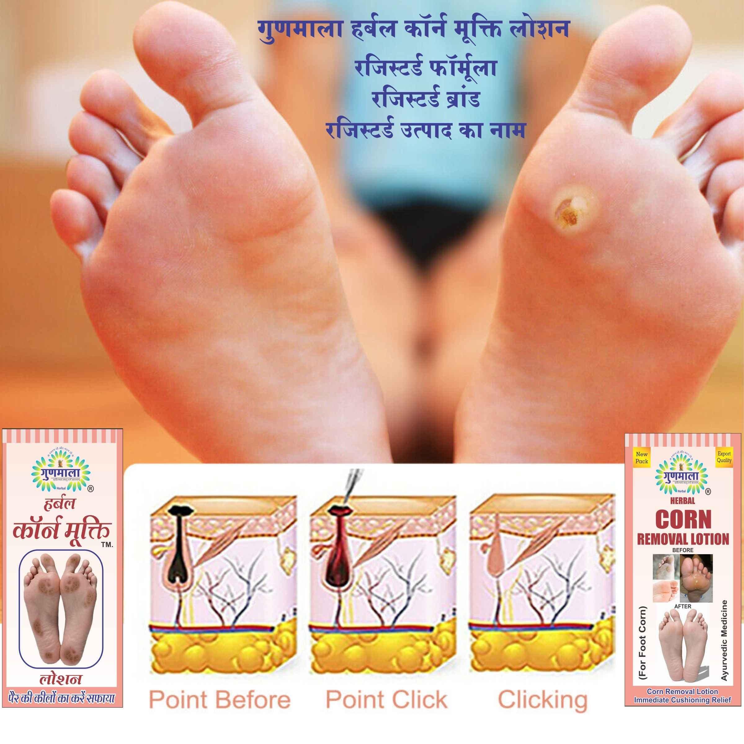 GUNMALA Herbal Foot Corn Lotion, For Remove Feet Fast And Relives From Pain & Pinch In Walking Best For Feet Infections, 5 Ml. Bottel Pack,Qty.-Pack Of 2