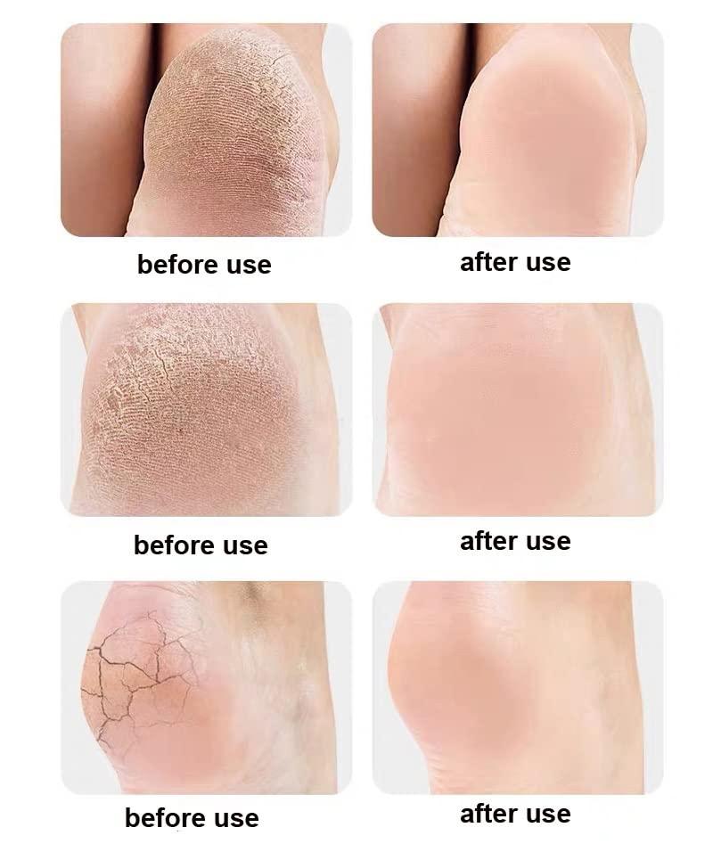 Shoppingekart Heel Pain Relief Products For Women Anti Crack Silicon Gel Heel And Foot Protector Moisturizing Socks for Foot Care,leg pain relief products And Heel Pad for Men & Women(Length Half|Free Size|10 Pair)