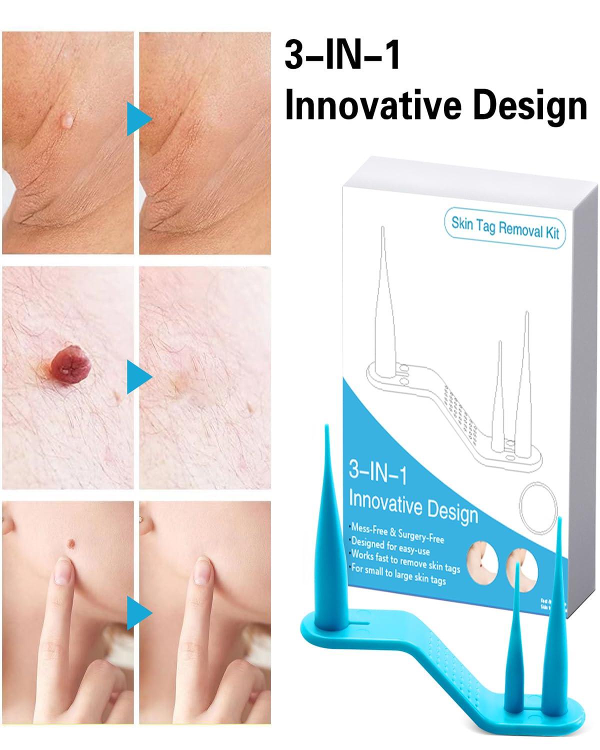 NHCDFA Skin Tag Remover Cream, Best Skin Tag Removal, Skin Tag Remover Kit, 3 in 1 Skin Tag Removal with Auto Skin Tag Remover, Face Care Mole Wart Tool, Skin Tag Remover Set