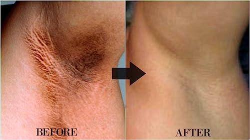 VEDANGAH VEDANGAH Anti Fungal Cream | Anti-Itching Skin Cream | Eczema | Psoriasis | Ringworm Cream 12Gm Pack Of 2