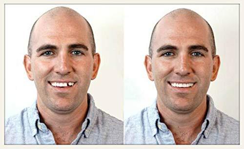 Instant Smile Instant Smile Select A Tooth Temporary Tooth Replacement Kit- Combo