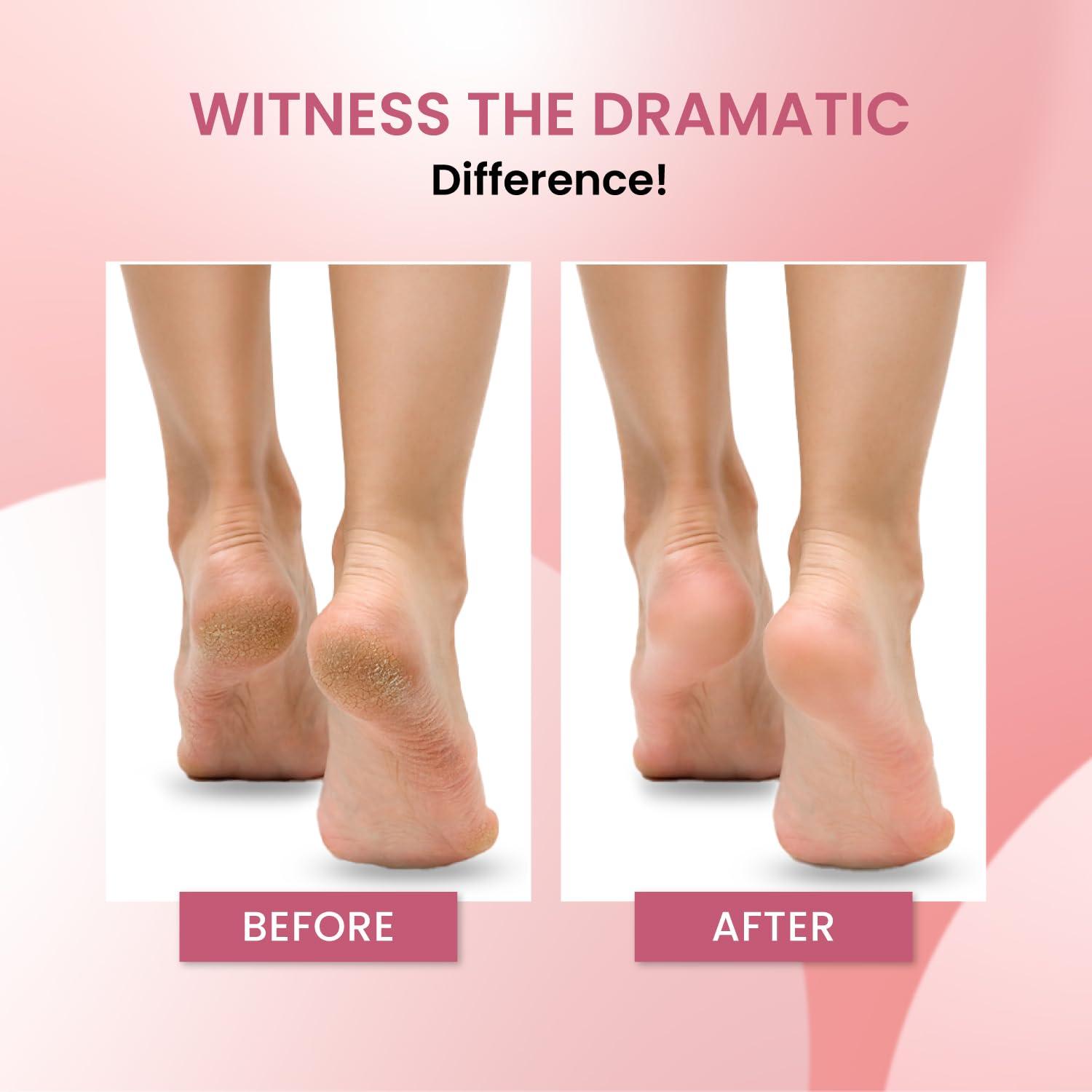 Urban yog Urban yog Callus Remover with 3 Interchangeable Head Rollers, Rechargeable, Callus & Dead Skin Removal, Pedicure Device Filer for Foot Care, 2 Speed Settings, Fast Type-C Charging, 1200mAh Battery