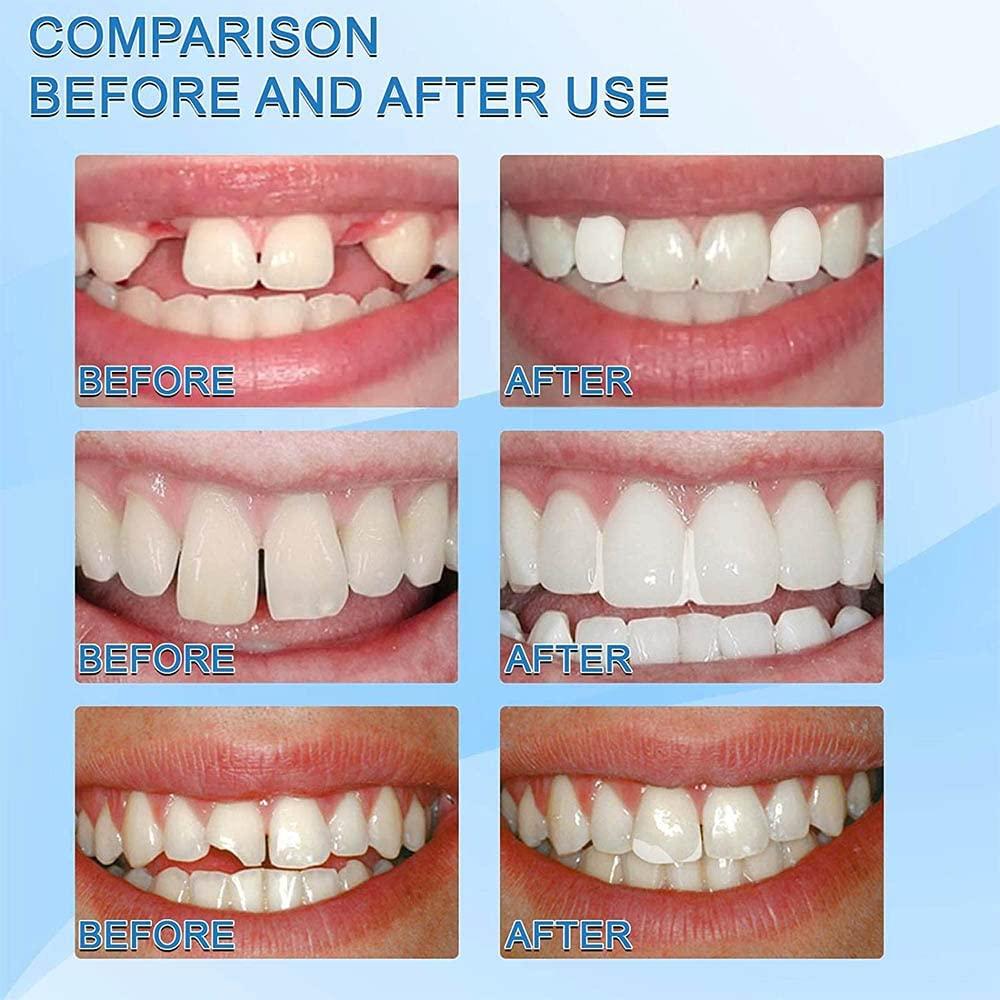 SHxxyljh Temporary Tooth Repair Kits,Dental Repair Denture Repair Beads,Tweezers,Dental Pick,Dental Tools for Temporary Fixing Filling Missing Broken Tooth Moldable Fake Teeth