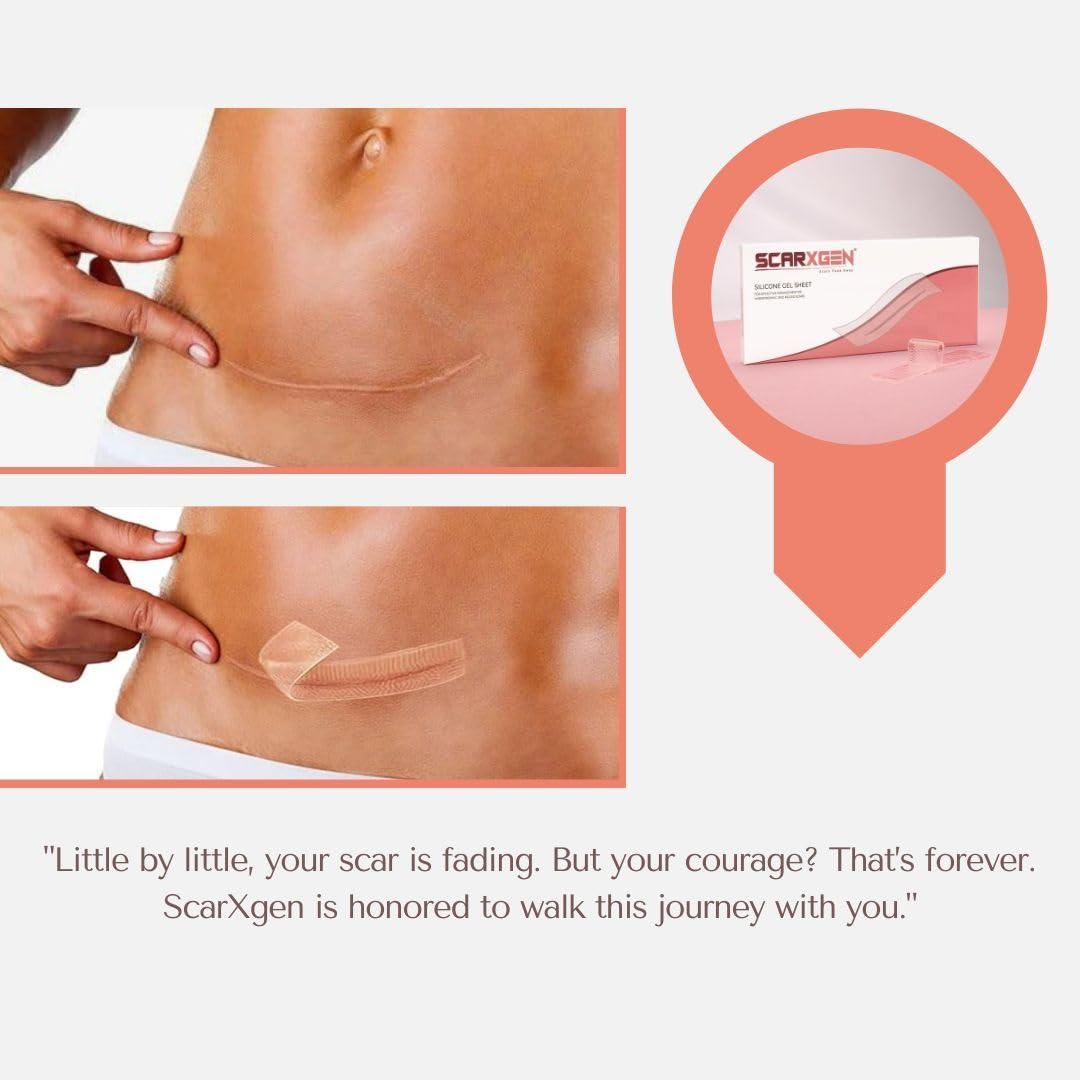 SCARXGEN Scarxgen Silicone Gel Sheet | Scar Sheet | Scars, Cuts and Scrapes, Laparoscopic scar | Reusable and Washable Sheet | Keloid and Hypertrophic scar I Visible scar reduction (3CMX20CM(BOX OF 1 UNIT))