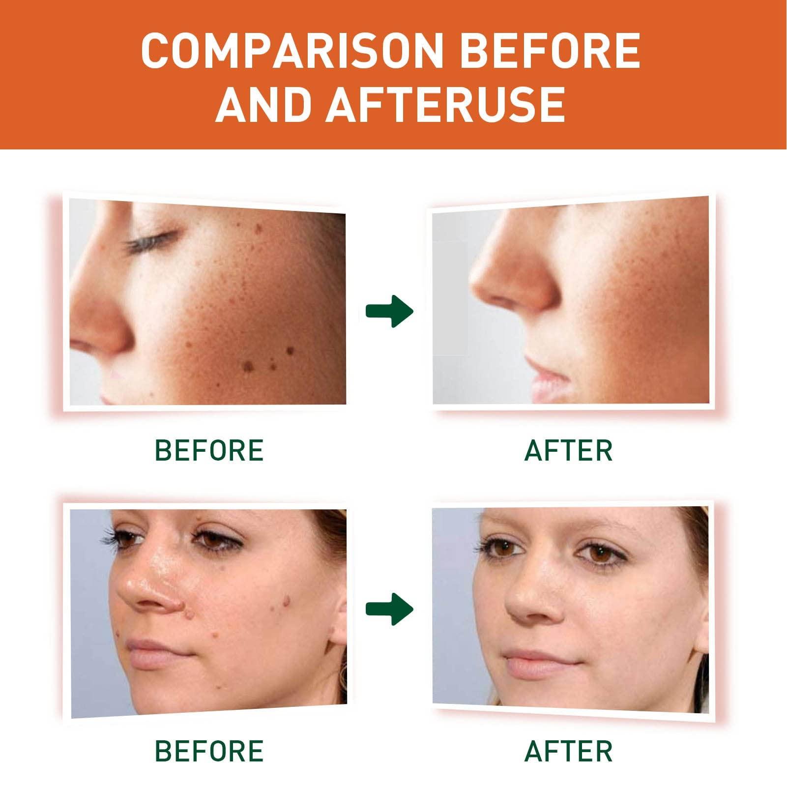 Jaerb Liquid Mole Remover, 30ml Painless Safe Mild Repairing Brush Tip Skin Tag Removal Liquid for Condyloma