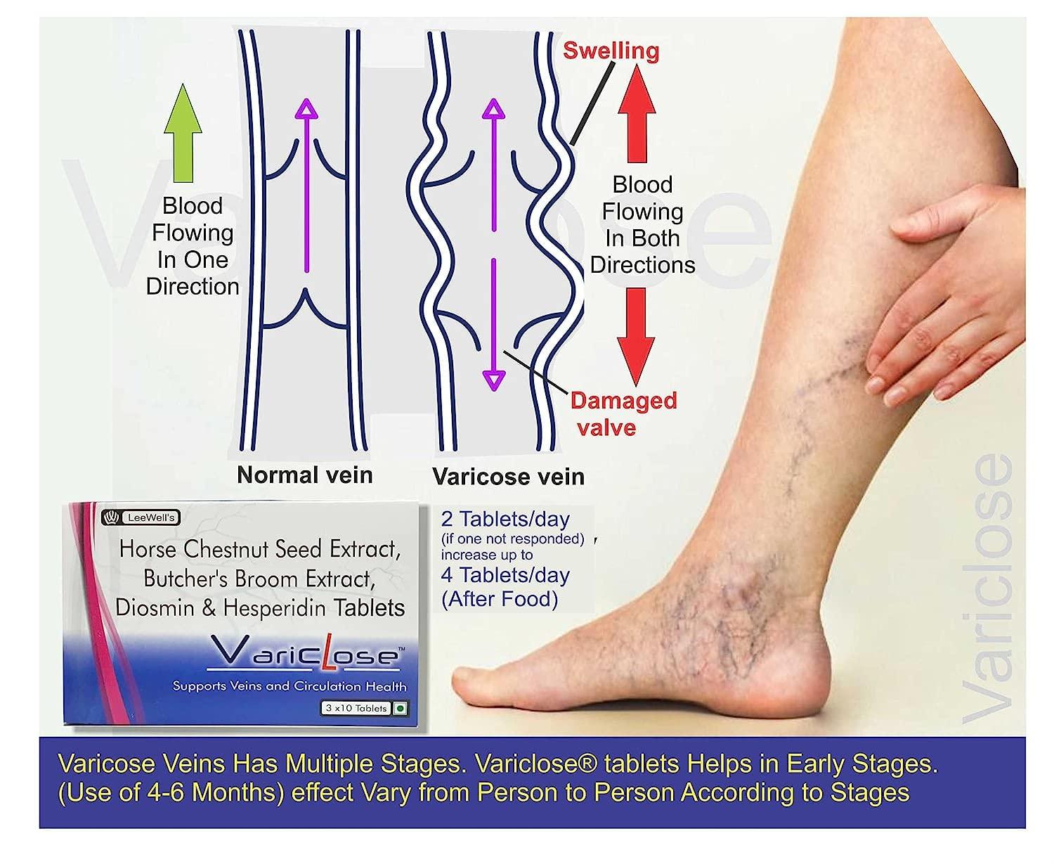 VARICLOSE Variclose Support Varicose Veins, Spider veins | Diosmin, Hesperidin, Horse Chestnut extract (Aescin), Butchers broom extract (Ruscogenins) | Plant based Foot, Legs Vascular Micro Circulation Support Supplement -60 Tablets