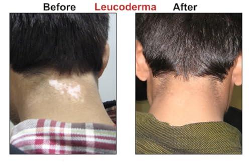 Arogya Ayurveda Kendra Herbal Remedy for Vitiligo & Leukoderma Helpful in disappearing White Patches from Skin.- Ayurveda Gift