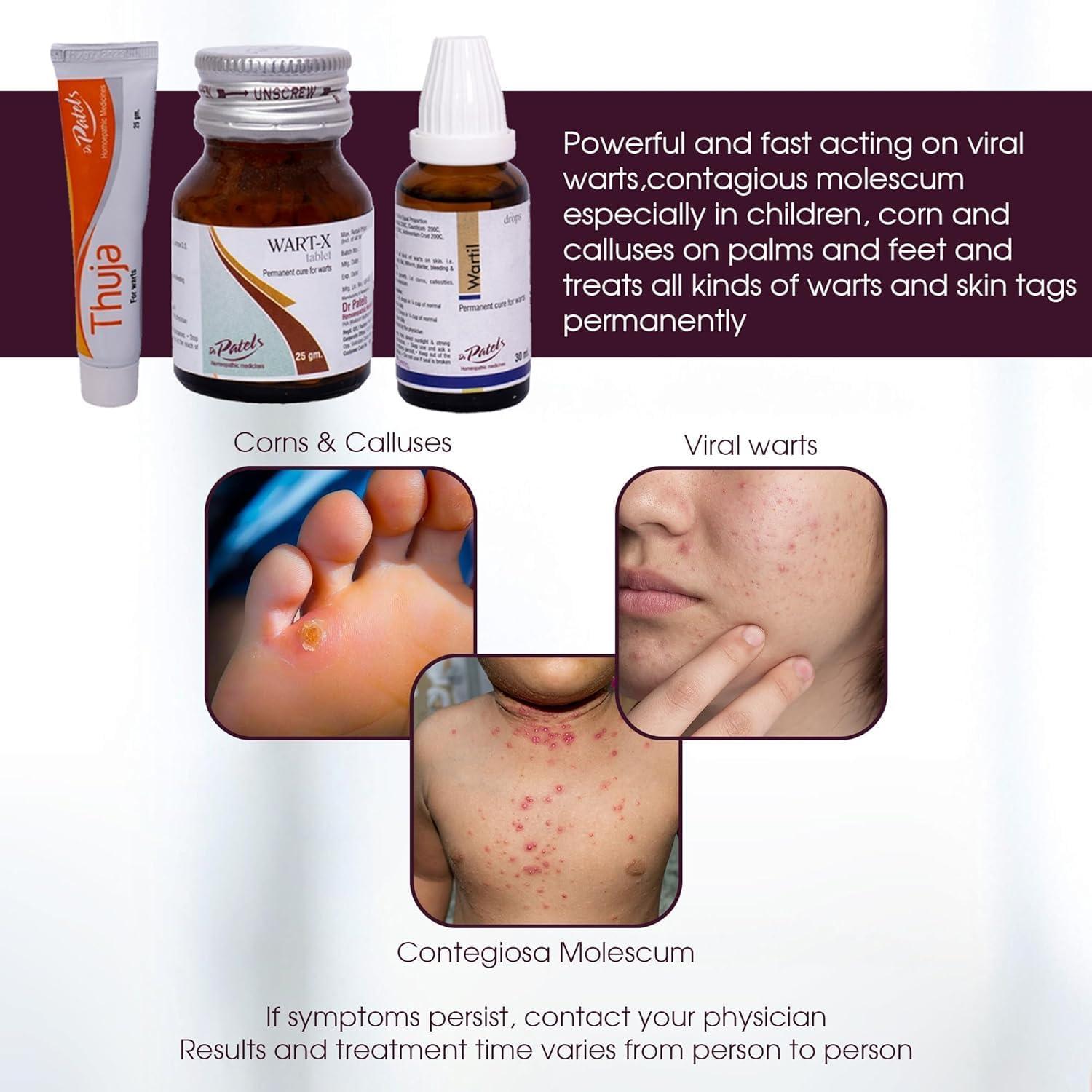 DR PATELS HOMEOPATHIC MEDICINES DR PATELS HOMEOPATHIC MEDICINES Wart X Tablet & Thuja Ointment Combo|Removal Of All Types Of Warts, Corns, Callosities|Polypi & Tubercles-Combo