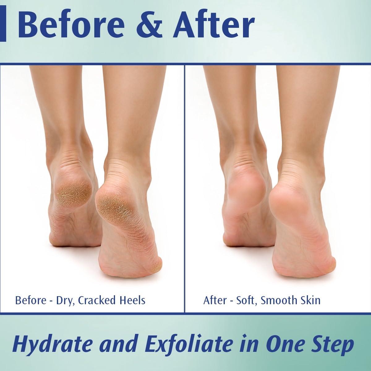 Pedifix Pedifix Podiatrists Choice 20% Urea Callus Control Extra Strength Foot Cream 4 Oz. (113g)