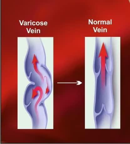 JOINTCOMFO Medical Antiskid Varicose Veins, Graduate Calibrated, Compression Socks, Stocking Improve Blood Circulation, Varicose Vein, Swollen, Aching Legs, Pain Relief, Edema, Sore Legs, Compression Sleeve with Anti Slip Grade-III, Unisex. (XL, Black)