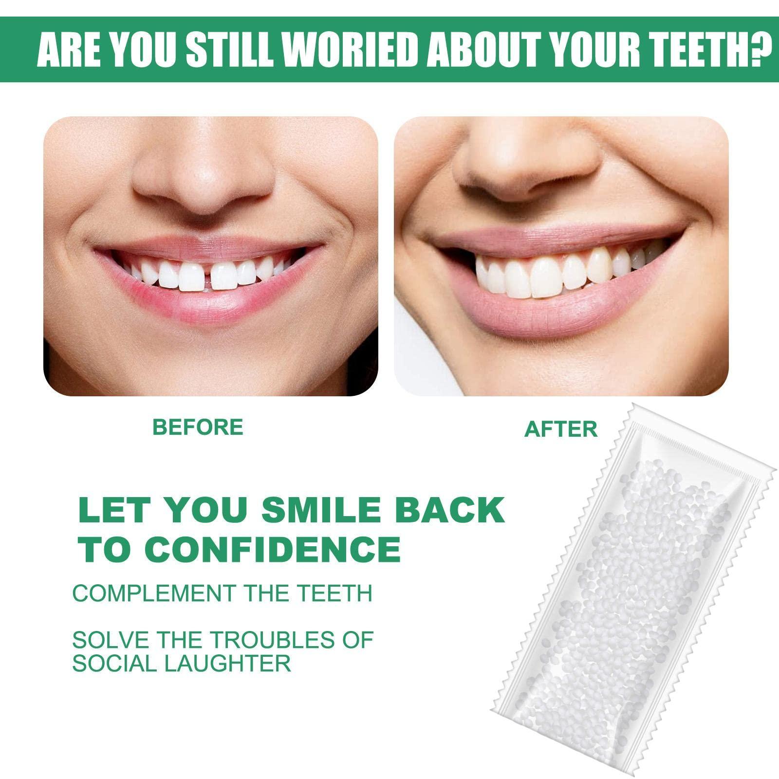 CALANDIS CALANDIS 1 Tooth Repair Kit DIY Tooth Filling Thermal Beads Temporary Teeth Repair Moldable 10G