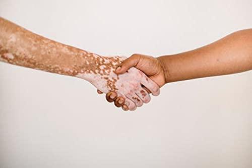 Arogya Ayurveda Kendra Herbal Remedy for Vitiligo & Leukoderma Helpful in disappearing White Patches from Skin.- Ayurveda Gift