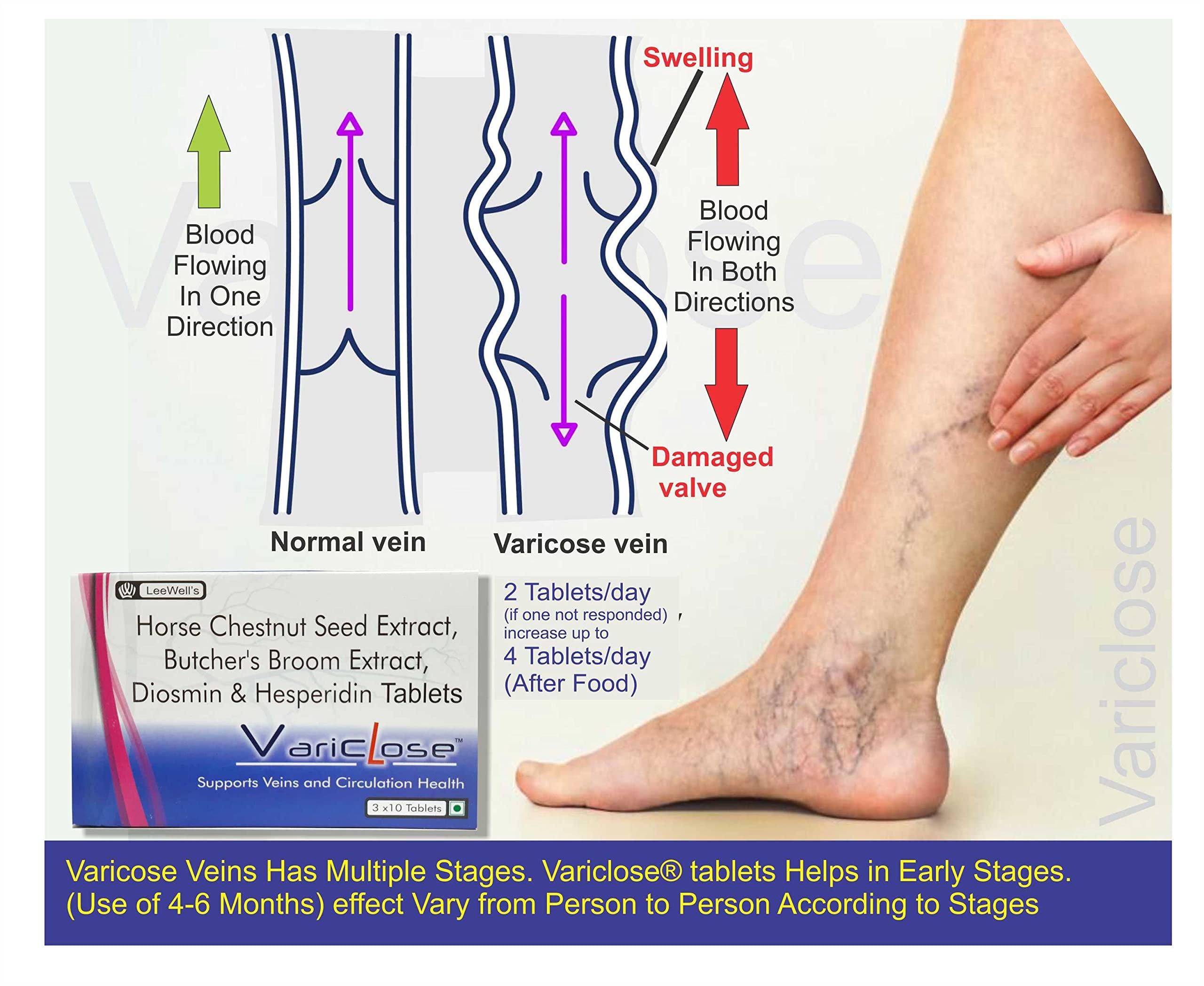 VARICLOSE Variclose Varicose Vein Support | Restless Legs Circulation Flow, Cramps, Twisted, Enlarged, Discolored Veins Aid | Diosmin, Hesperidin, Horse Chestnut extract (Aescin), Butcher\'s broom extract (Ruscogenins) - 30 Tablets (Leewell Pharma)