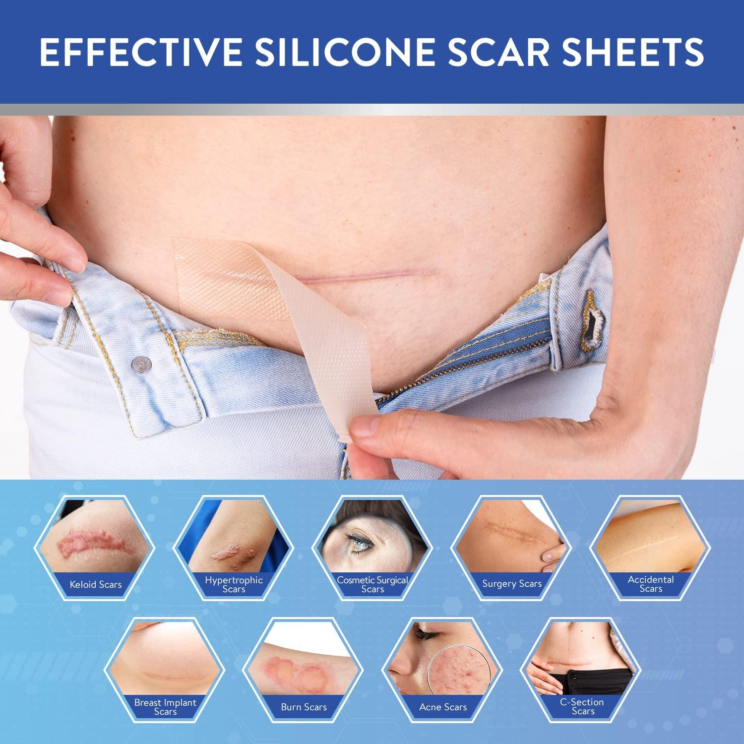 Retailio Retailio Silicone Scar Sheets Silicone Scar Tape 1.6x60" for Softening and Flattening Scars, C-Section, Keloid Surgery, Painless Removal, Reusable, Washable