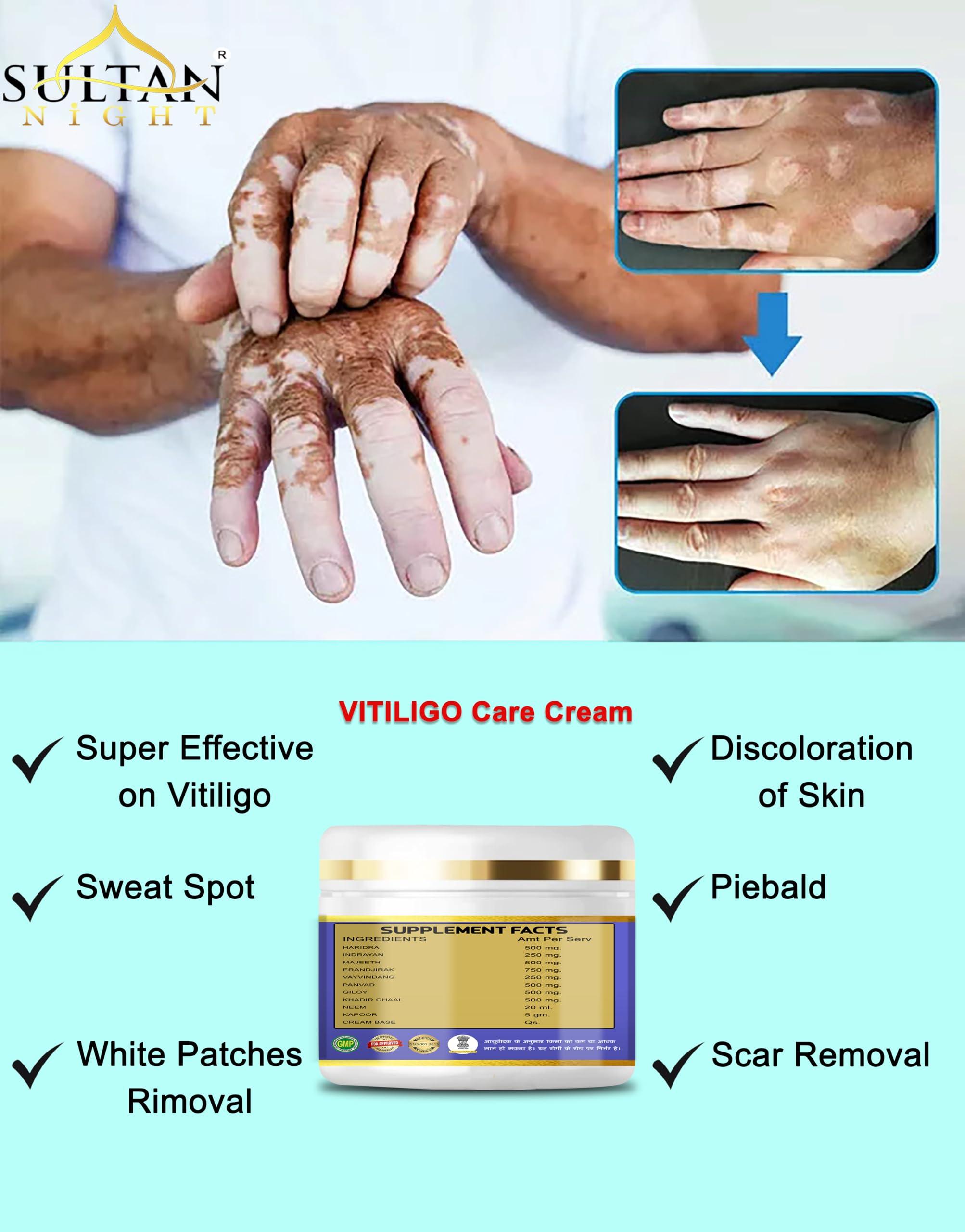 Sultan Night Sultan Night Vitiligo cream 100gm | Super Effective on Vitiligo | White Patches, Discoloration of Skin, Scar Removal, Piebald, Sweat Spot for men and women(2x50g)