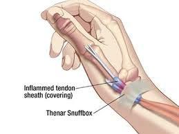 METRON METRON-Hand Arm Wrist Support Slope Elevator for Recovery, Stabilization from Swelling Edema Splinting Fabrication Stroke Recovery
