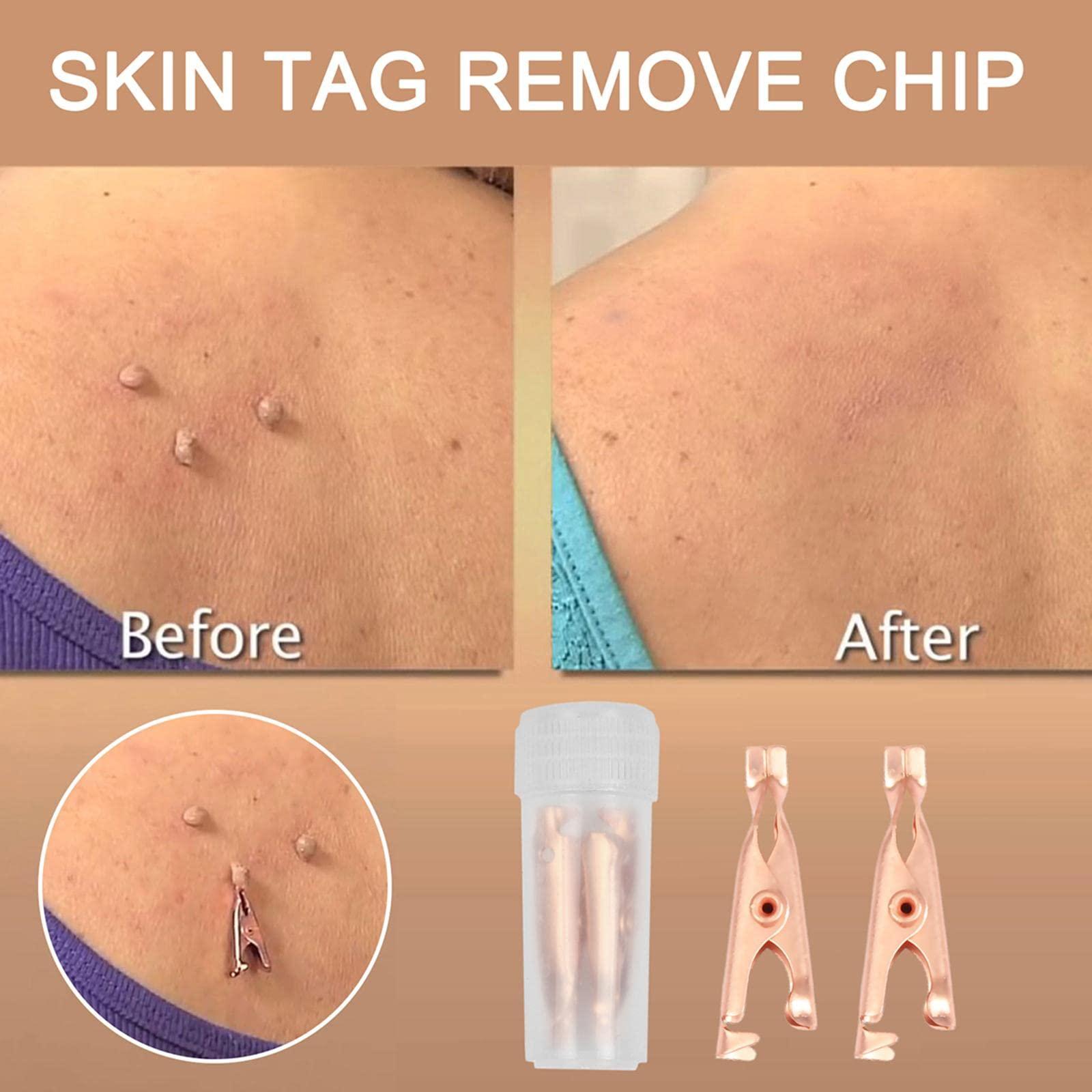 T.O.G. T.O.G. Small Skin Tag Removal Clips Copper Tag Out Wart Tag Extractor Unisex 12Pcs