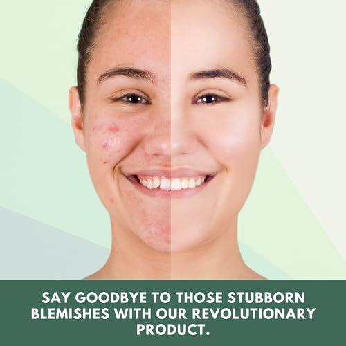 Healthy Nutrition - Just for the Health of it Healthy Nutrition - Just for the Health of it Neem For Acne Free Skin, Blood Purifier To Reduce Pimples On Face (60 Tablets)