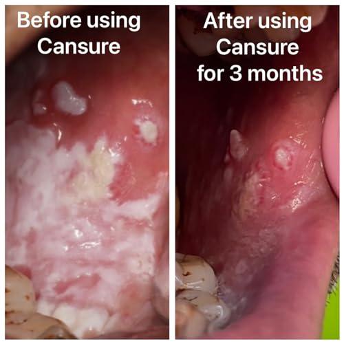Cansure Cansure Toothpaste (Pack of 3) The World\'s First Patented Toothpaste for Oral Pre-cancerous Conditions*| Pre-malignant Red and White Lesions | Contains Nano Partical-based Patented Molecules with a better absorption rate | Nothing worked yet? Try Ca
