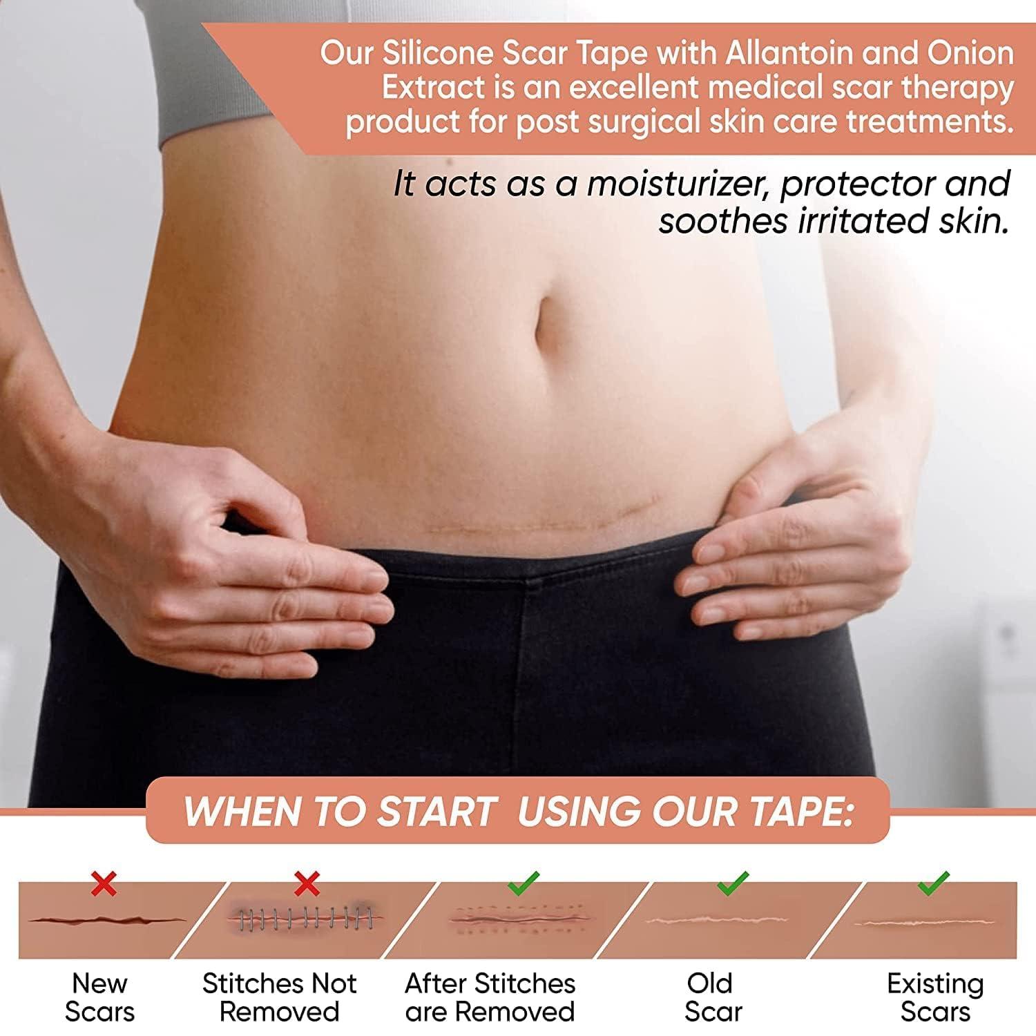 CLOSAL CLOSAL® 1 Roll Silicone Scar Sheets Waterproof Cica Care Gel Sheets Wound Repair Desalination Strip Scar Removal Sticker for Surgery Injury Burns Scars