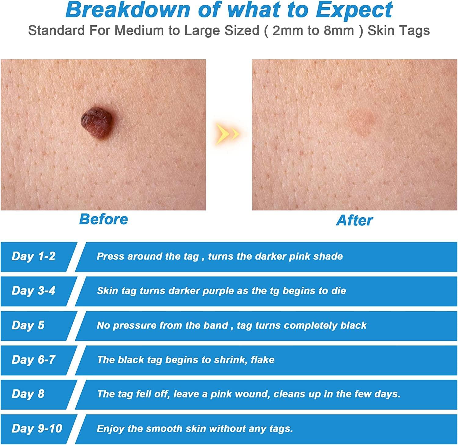 Wifamy Skin Tag Remover,Painless Skin Tag Remover Pen,Skin Tag Removal Kit Tools with 40 Micro and Regular Skin Tag Bands,Easy Skin Tag Remover Device to Remove(2mm-8mm) Skin Tags (2in1 Kit)