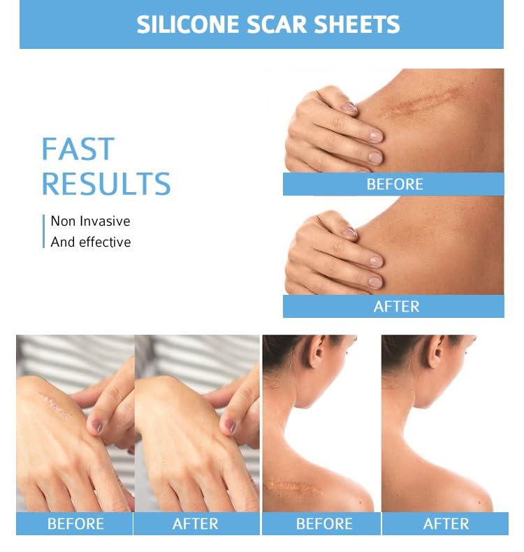 EASTHILL EASTHILL Silicone Scar,Silicone Scar Tape Effective Scar Removal Sheets, Silicone Scar Removal Sheets for Surgical Scars,Healing Keloid, C-Section, Tummy Tuck (SCARE SHEET)