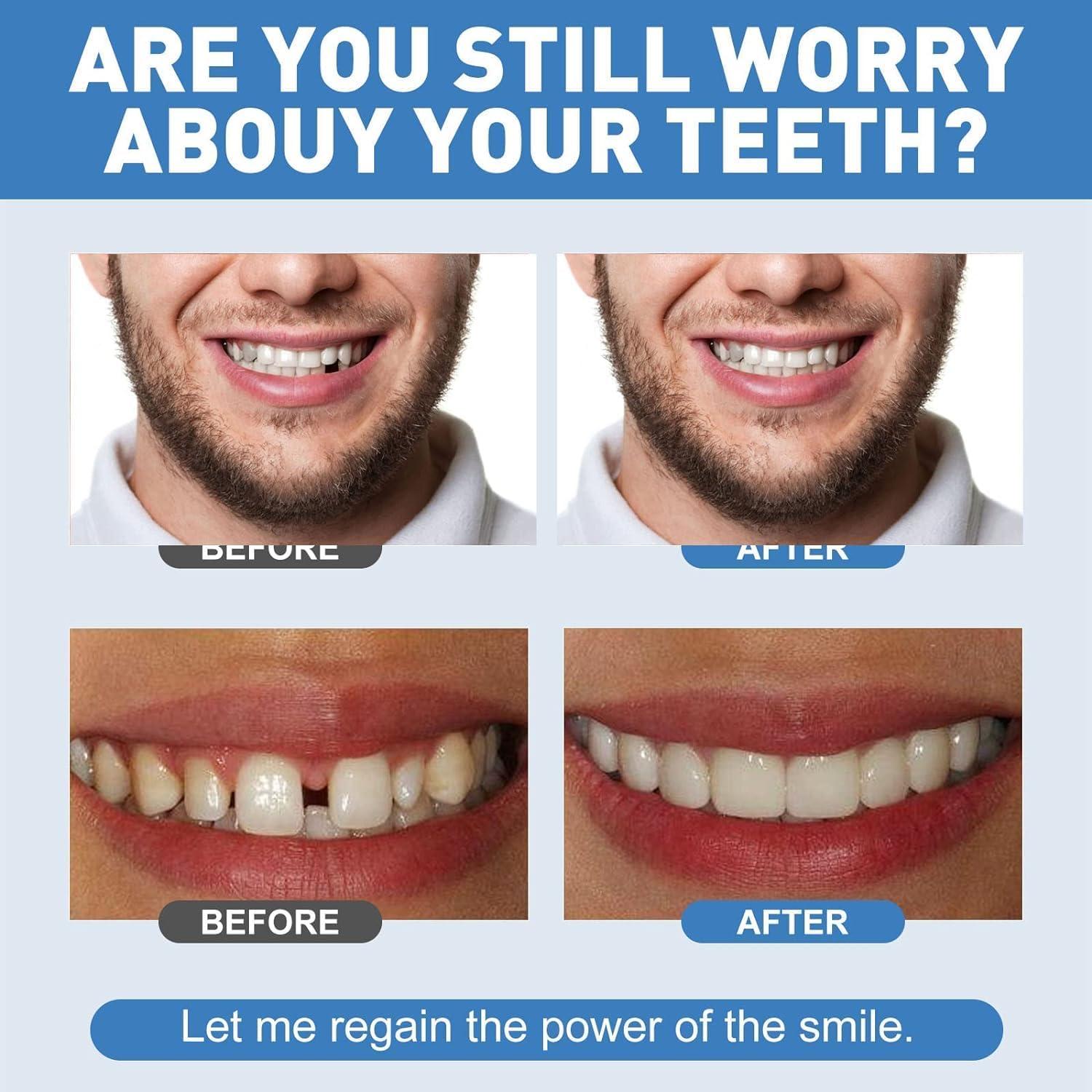 NavaFresh Basics Tooth Repair Kit, Temporary Teeth Gap Repair Kit, Temporary Teeth Replacement Kit, Tooth Repair Shaping Teether Kit