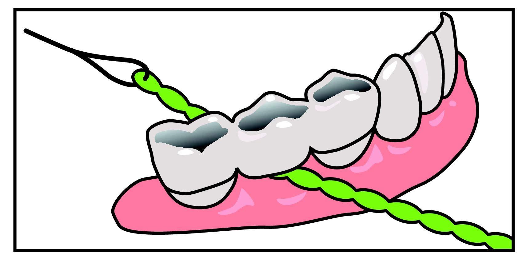 iDontix Idontix X-Floss 30 Strands Easy Bridge And Implant Floss by Idontix