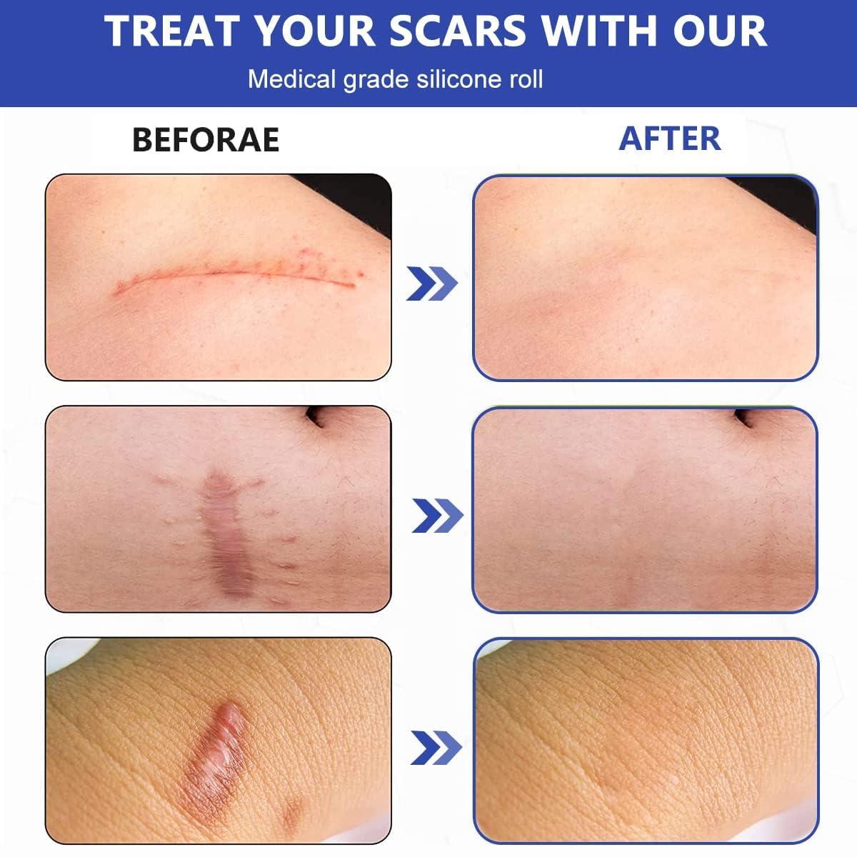 LUPINEZ LUPINEZ Transparent Medical Silicone Gel Tape for Scar Removal,Scar Transparent for Surgical Scar, Silicone Scar Sheets, Silicon gel sheets for Scars