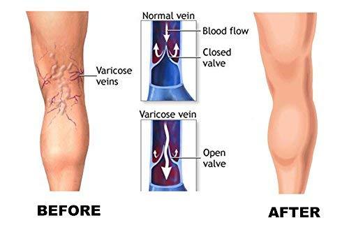 MGANG Compression Socks, Open Toe, 15-20 mmHg Graduated Compression Stockings for Men Women, Knee High Compression Sleeves for DVT, Maternity, Pregnancy, Varicose Veins, Relief Shin Splints, Beige XXL