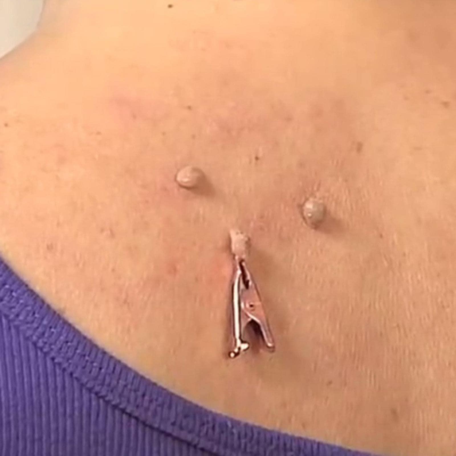 T.O.G. T.O.G. Small Skin Tag Removal Clips Copper Tag Out Wart Tag Extractor Unisex 12Pcs