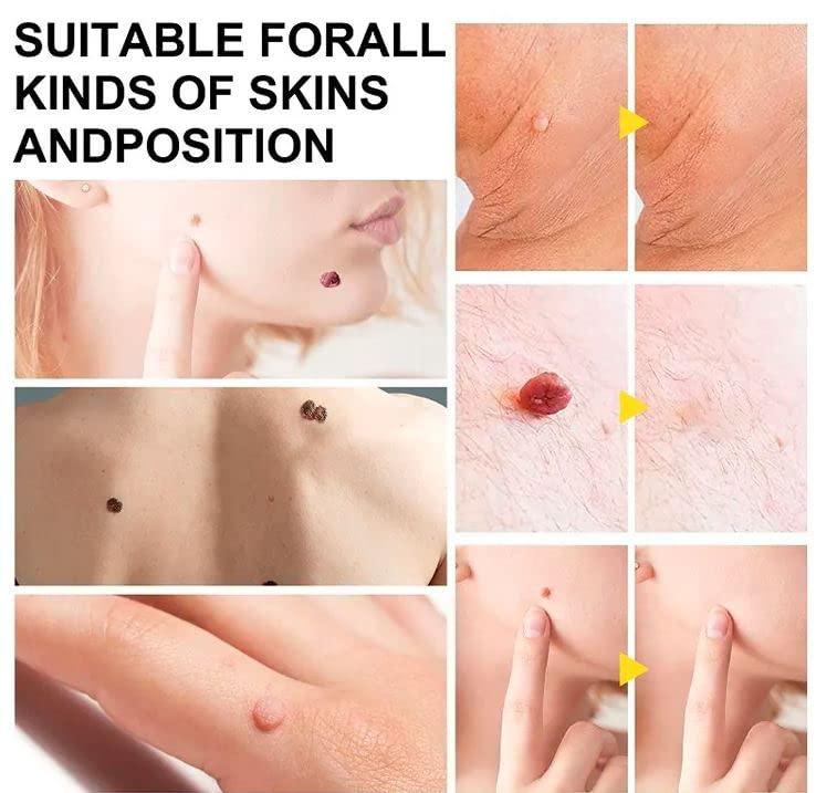Generic Auto Skin Tag Remover Kit, Skin Tag Removal Patch, Skin Tag Remover Kit 2 in 1 Skin Tag Removal