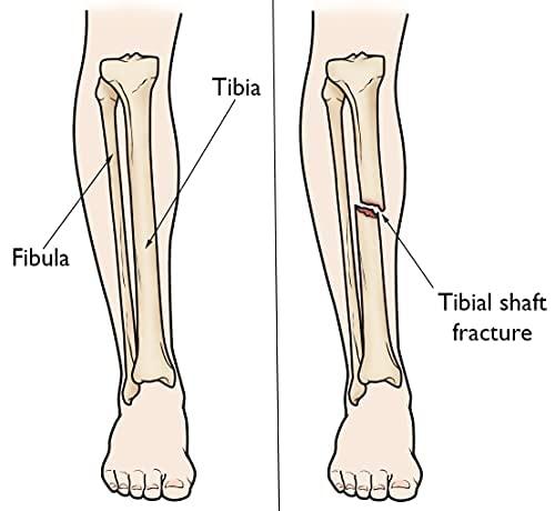 DEBIK DEBIK | Tibia brace/Tibial Support For Leg, calf and Fibula Fracture Orthosis External Fixation (SMALL)