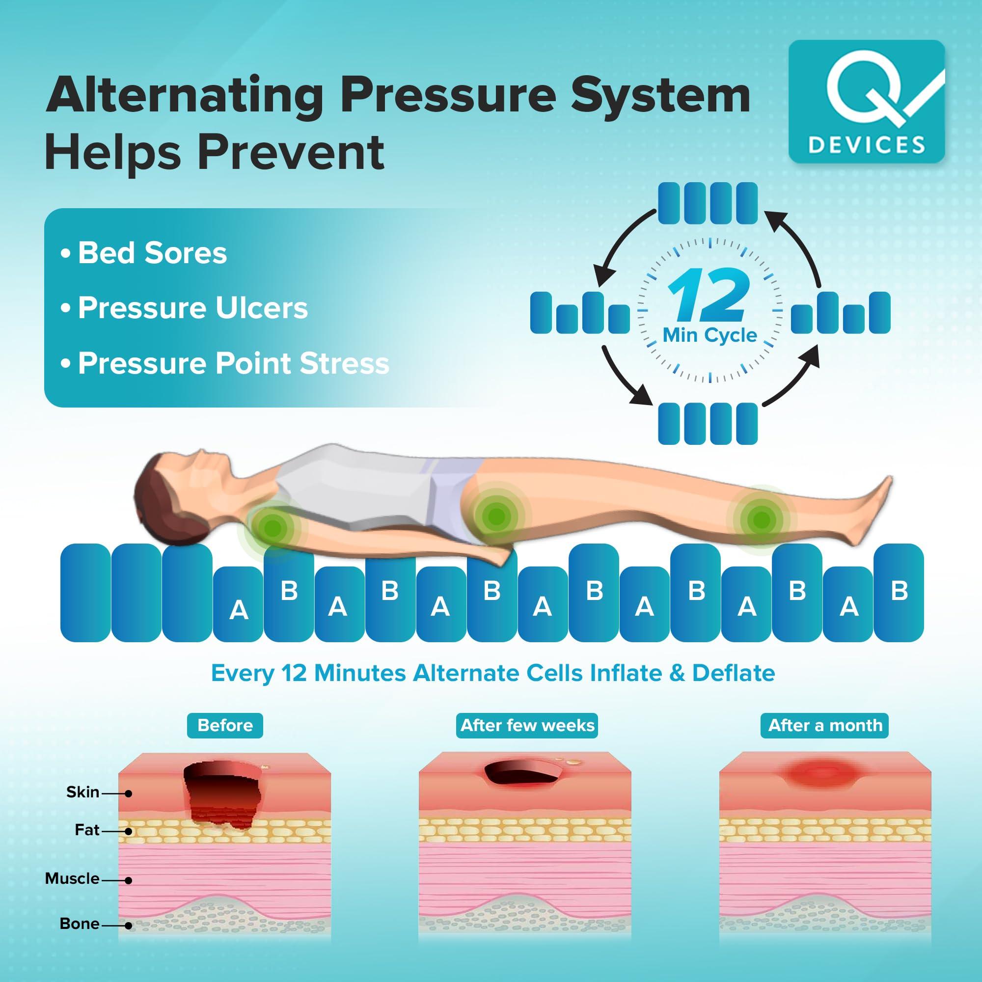 Q DEVICES Q DEVICES Portable Bubble Air Mattress with Compressor, Helps Prevent Bed Sore & Ulcers, Alternative Pressure Therapy, Anti-Decubitus Anti-Bedsore Bubble Pad Mattress