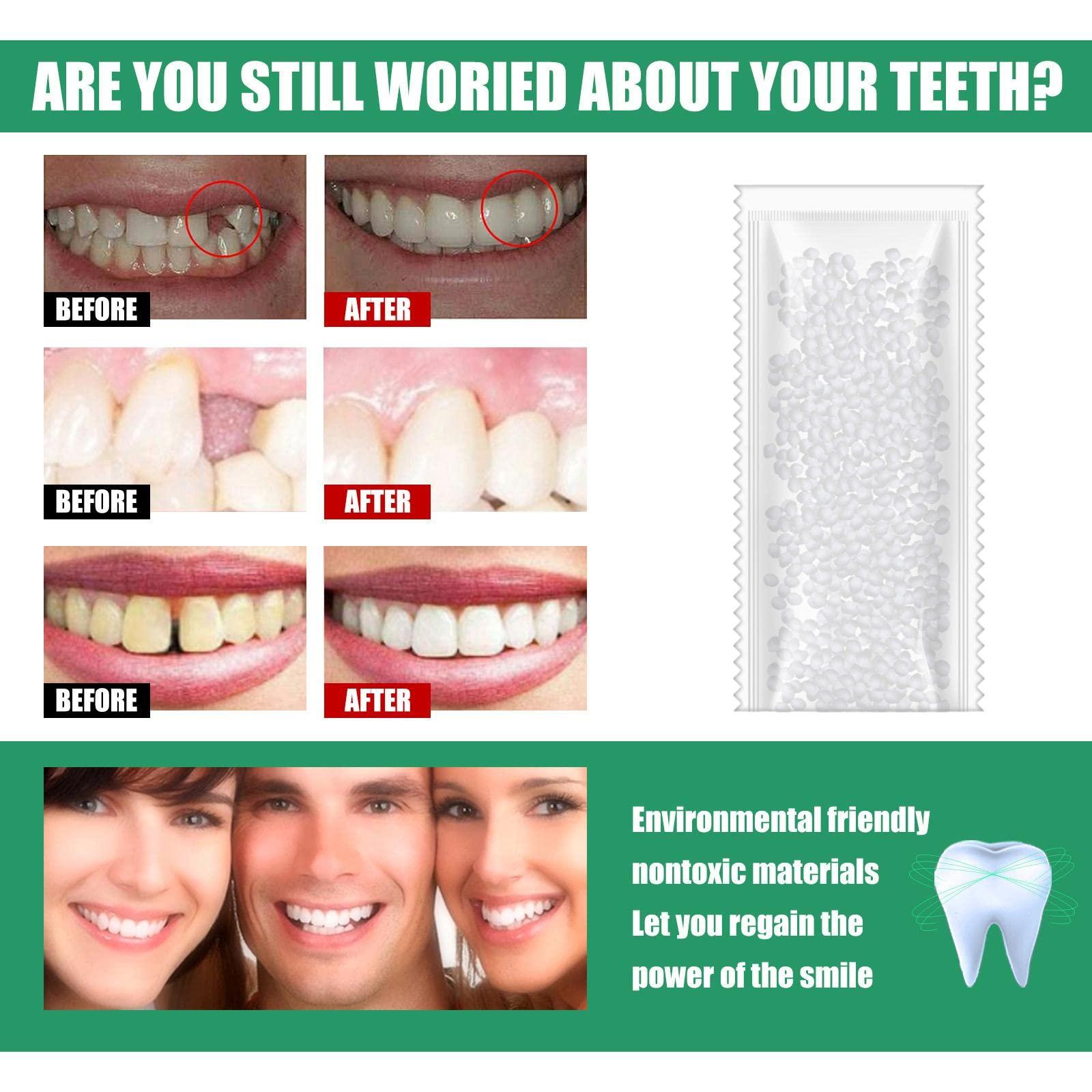 CALANDIS CALANDIS 1 Tooth Repair Kit DIY Tooth Filling Thermal Beads Temporary Teeth Repair Moldable 10G