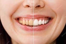 Generic Sensopower Toothpaste Potassium Nitrate Sodium Monofluorophosphate & Triclosan 100 gram gel. Relief from the Pain of Sensitive Teeth