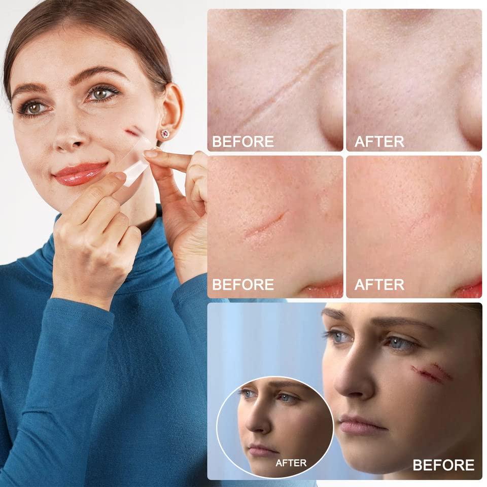 BOXANIA Boxania® Clear Silicone Scar Sheets, Silicon gel sheets for Scars Transparent Medical Silicone Gel Tape for Scar Removal, Silicone Scar Tape Roll For Hypertrophic Scars and Keloids Caused by Surgery