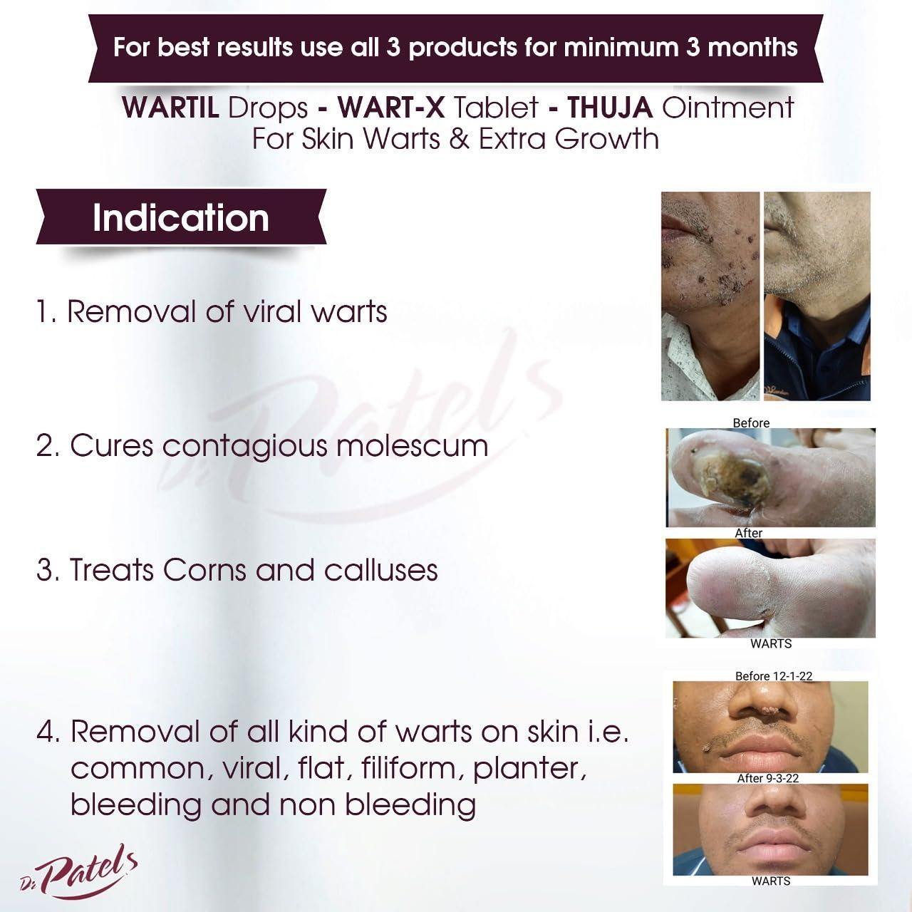 DR PATELS HOMEOPATHIC MEDICINES DR PATELS HOMEOPATHIC MEDICINES Wart-X Tablet - Permanent Cure For Warts | Removal Of All Types Of Warts, Corns, Callosities, And Contagious Molluscum- 25 Gm (Pack Of 1)