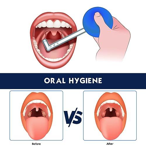 TOTOKA Tonsil Stone Remover Vacuum Kit Manual Style Cleaner Removal Tonsil stone remover vacuum Suitable for Oral Cleaning Oral Care Blue 1Pcs