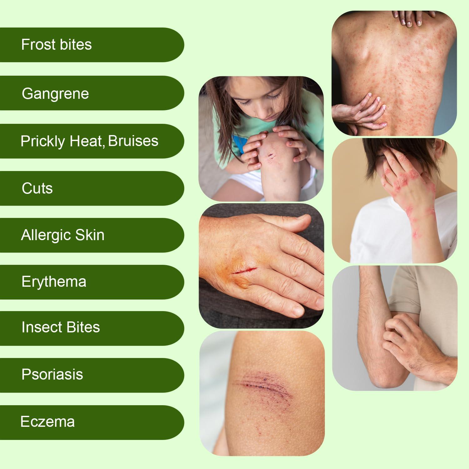 ebnl Ebnl Ayurvedic Calm Cream 50gm | Healing Ointment for Bruises, Burns, Sores, Ulcers, Skin Cracks, Scars, Rashes, Redness, Fungal Infections, Eczema Relief | Injury Scar | Surgery Scar | Scar Removal Cream | Keloid Remover | Safe for Infants & Babies