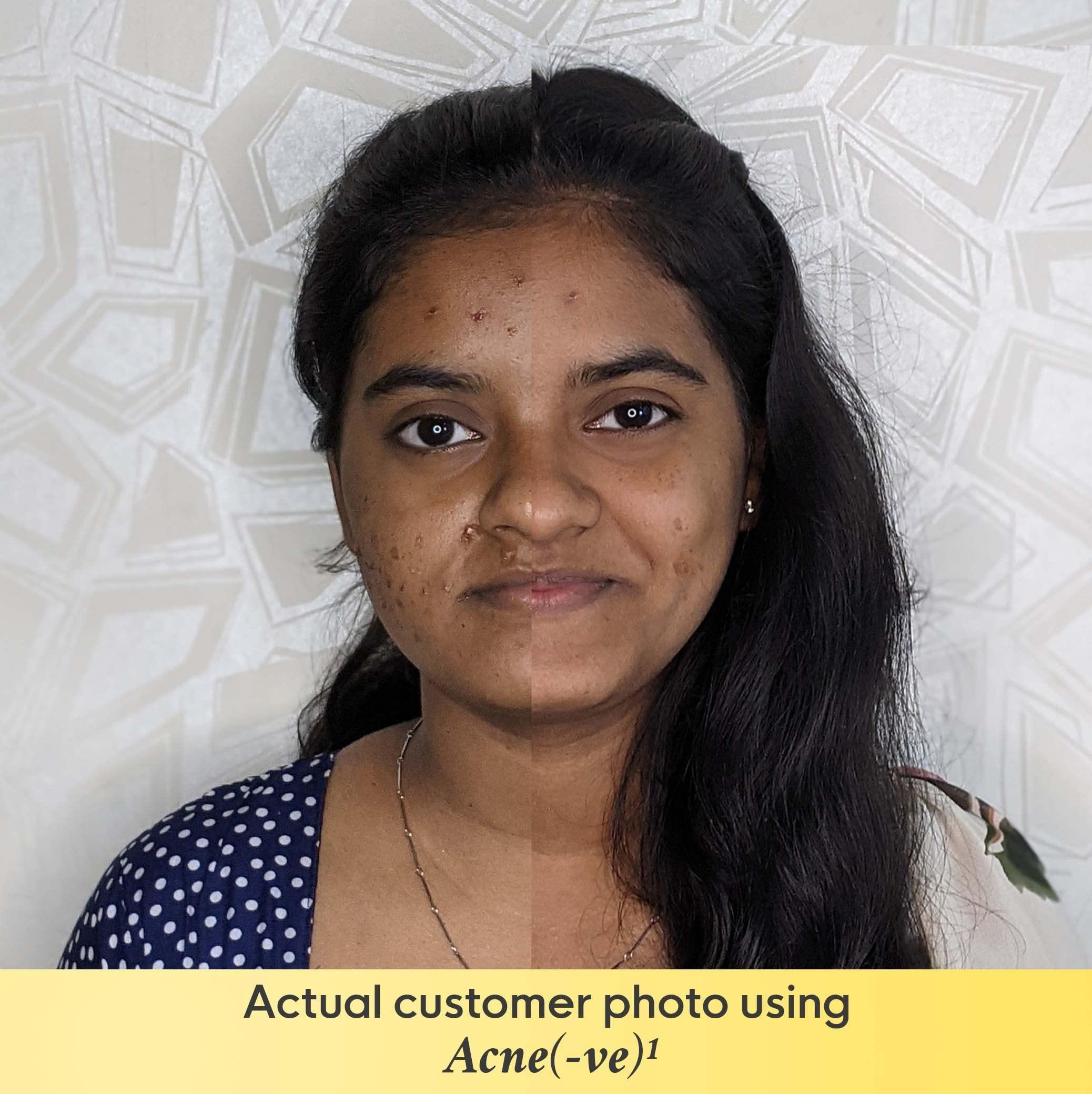 I AM LOVE I AM LOVE Acne Negative (-Ve) Supplement Powder - 60G|Reduce Excess Oil, Mild To Moderate Acne Pimples & Open Pores|Plant-Based Skin Supplement With B Complex Vitamins, Zinc, Chromium