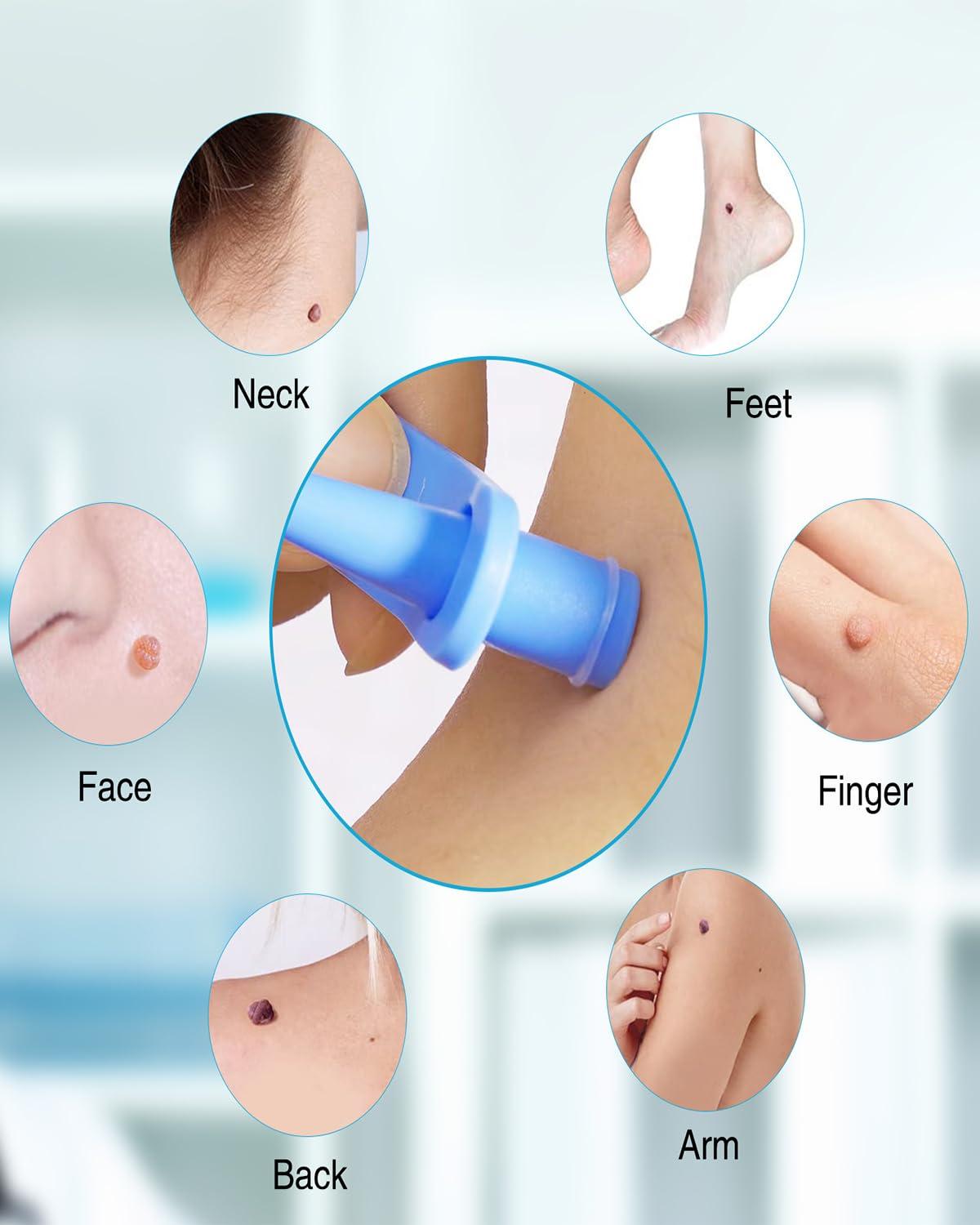 NHCDFA Skin Tag Remover Cream, Best Skin Tag Removal, Skin Tag Remover Kit, 3 in 1 Skin Tag Removal with Auto Skin Tag Remover, Face Care Mole Wart Tool, Skin Tag Remover Set