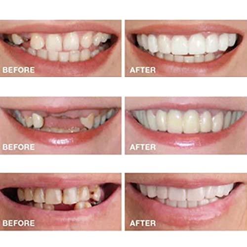 icehao Teeth Brace Cover Instant Smile Teeth Veneers Beautiful Smile Dentures Veneers Fake, Veneers Dentures Socket for Women and Men, Dental Veneers for Temporary Tooth 2pcs Repair