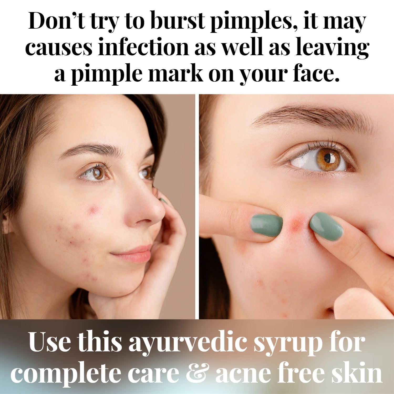 Healthally Healthally Ayurvedic Blood Purifier Rakt Shodhan Syrup|Pimple Acne Remover Skin Cleanser Tonic|Improves Skin Health & Wellness,Detox Blood Impurities|Safe For Men Women - 500 ML