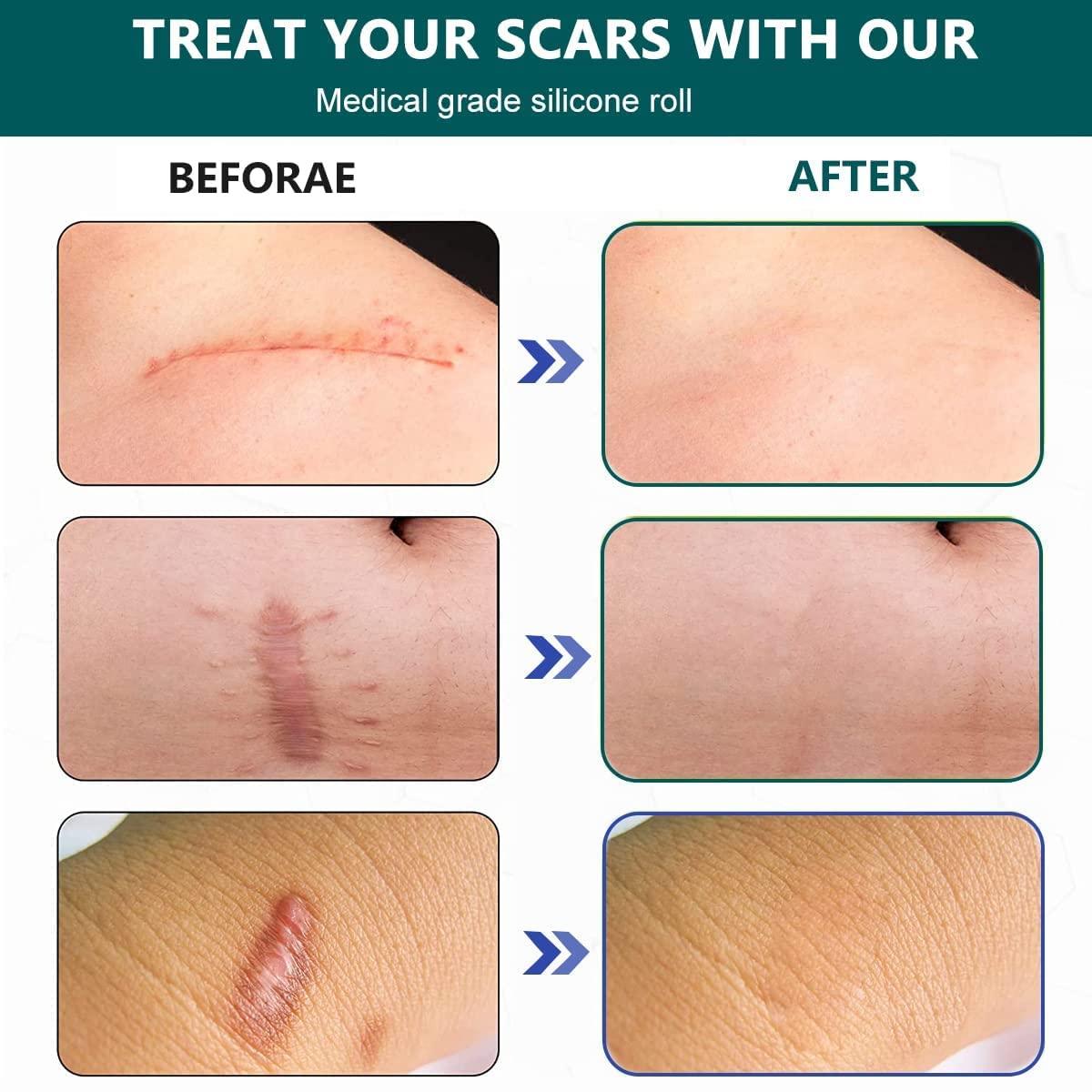 CLOSAL CLOSAL® 1 Roll Silicone Scar Sheets Waterproof Cica Care Gel Sheets Wound Repair Desalination Strip Scar Removal Sticker for Surgery Injury Burns Scars
