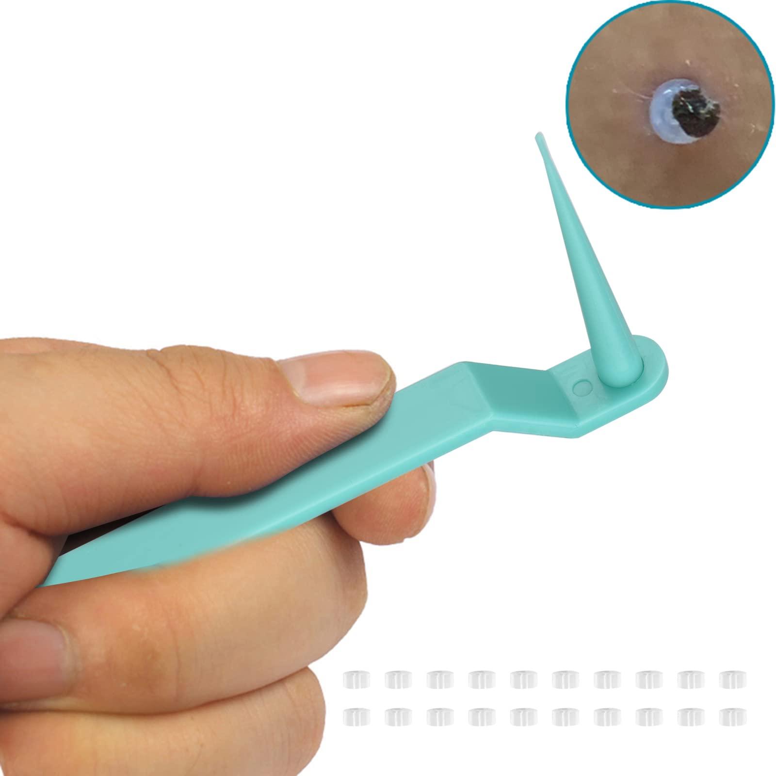 RYAP Skin Tag r Skin Tag Removal Kit for Removing Small to Medium (2mm to 4mm) Sized Skin Tags Painlessly