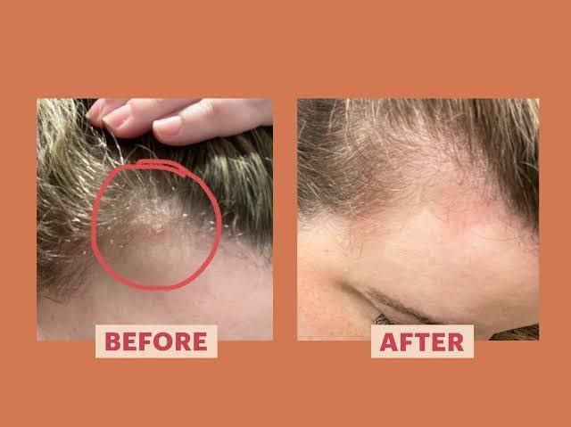 Generic Psorex Oil for Psoriasis, 100 ml x 2 Pack, by Shankar Pharmacy